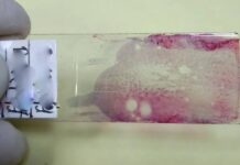 AI reads the ‘geography’ of pancreatic tumors to predict who’s most likely to relapse