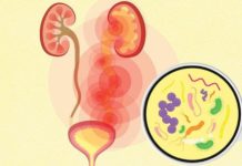 Algorithm helps doctors pick the right antibiotics for UTIs antbiotics