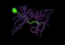 Siemens introduces AI-powered angiography systems for liver cancer embolization