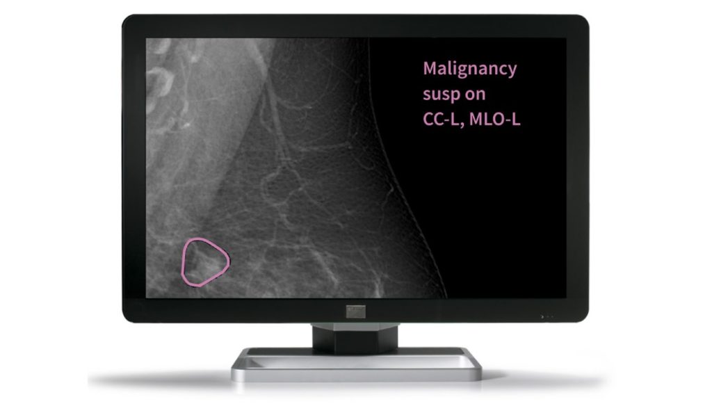 Mia breast screening AI