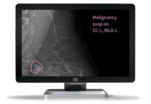 Kheiron’s breast screening AI Mia could help radiologists detect the breast cancer Mia breast screening AI