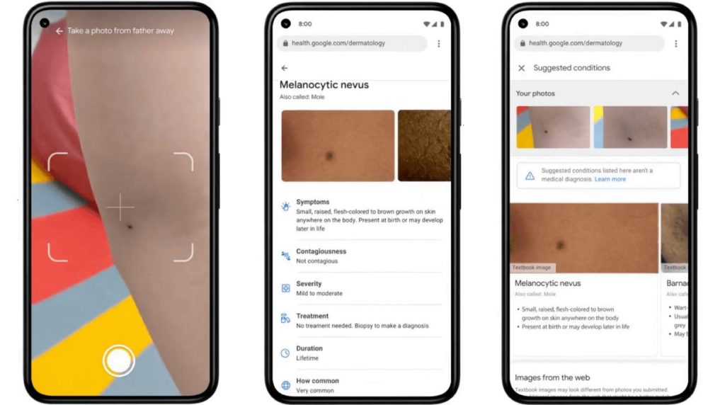 Using AI to help find answers to common skin conditions